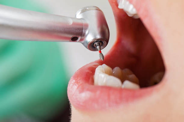Best Emergency Wisdom Teeth Removal in Poynette, WI